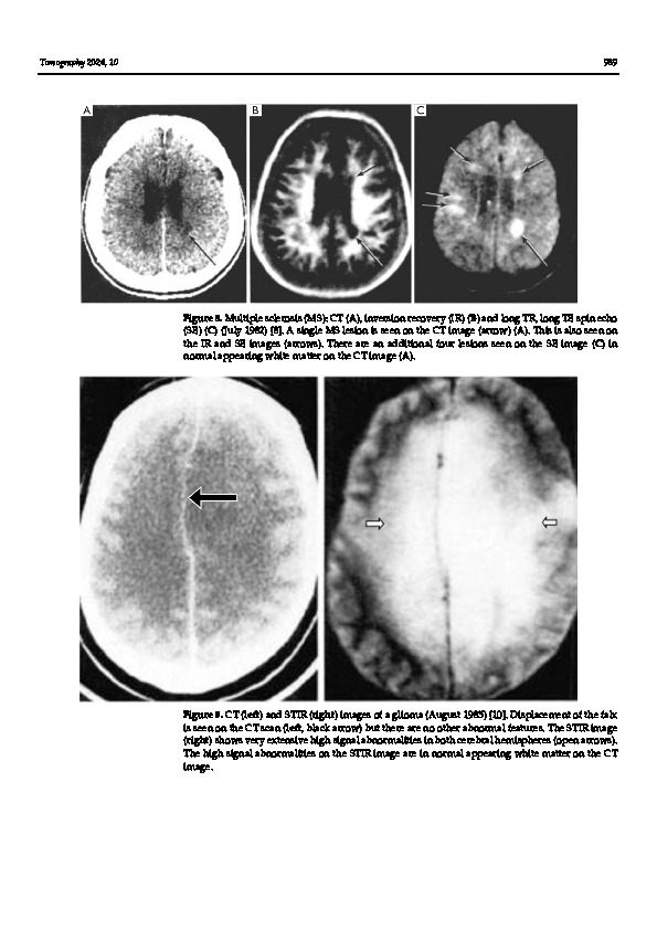 Download Ultra-High Contrast MRI: The Whiteout Sign Shown with Divided Subtracted Inversion Recovery (dSIR) Sequences in Post-Insult Leukoencephalopathy Syndromes (PILS).