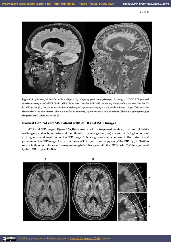 Download Ultra-High Contrast MRI of the Brain and Spinal Cord using Directly Acquired and Synthetic BipoLAr Inversion Recovery (BLAIR) Images, Preprints.