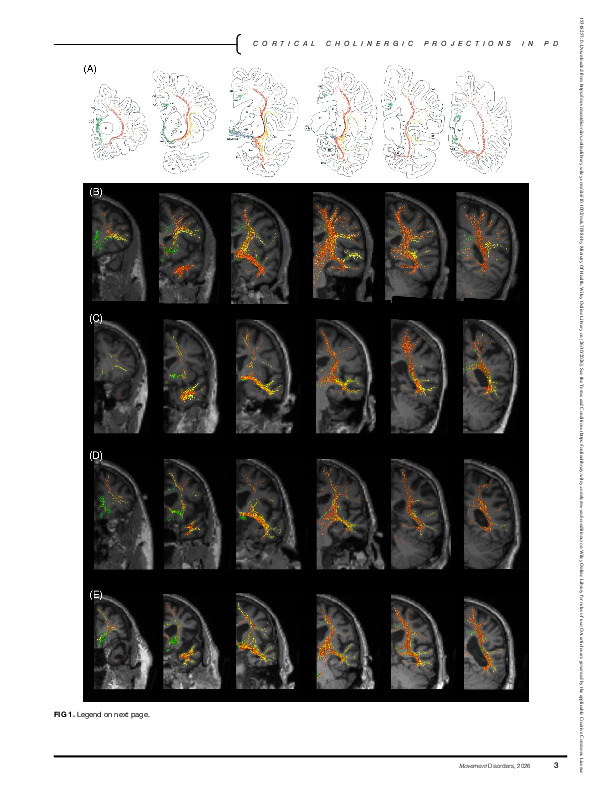Download Cortical Cholinergic Pathway Degeneration Reflects Cognitive Impairment and Dementia in Parkinson's Disease.